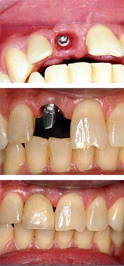implant diş istanbul şişli